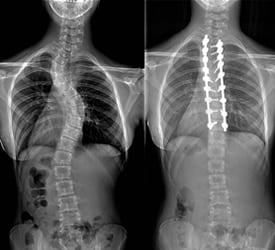 Double Thoracic Scoliosis