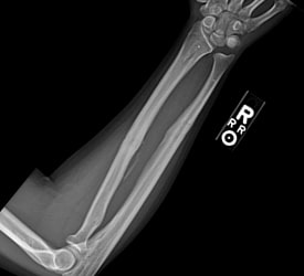 Both Bone Forearm Fracture – Recovery