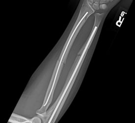 Both Bone Forearm Fracture – Post Op