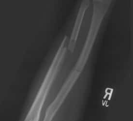 Both Bone Forearm Fracture – Pre Op