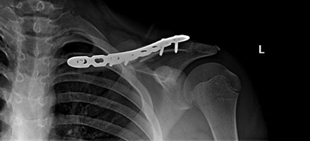 Clavical Fracture – Post Op