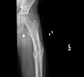 Femoral Shaft Fracture – Recovery