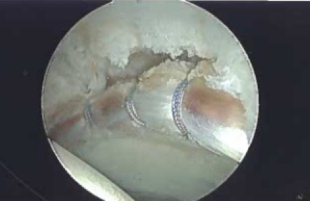 Labral Repair