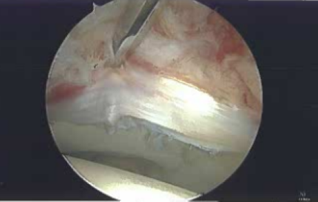 Labral Repair