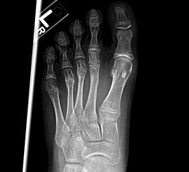 Metatarsal Fracture – Recovery