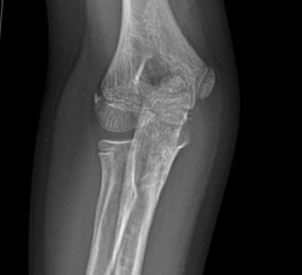 Monteggia Fracture – Recovery