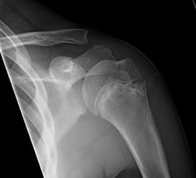 Proximal Humerus Fracture – Recovery