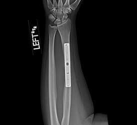 Radial Shaft Fracture – Post Op