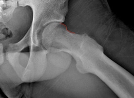 Reshaping after Arthroscopic Re-Contouring and Labral Repair