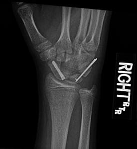 Right Scaphoid Fracture Post-Op