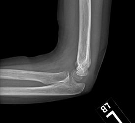 Supracondylar Fracture – Recovery