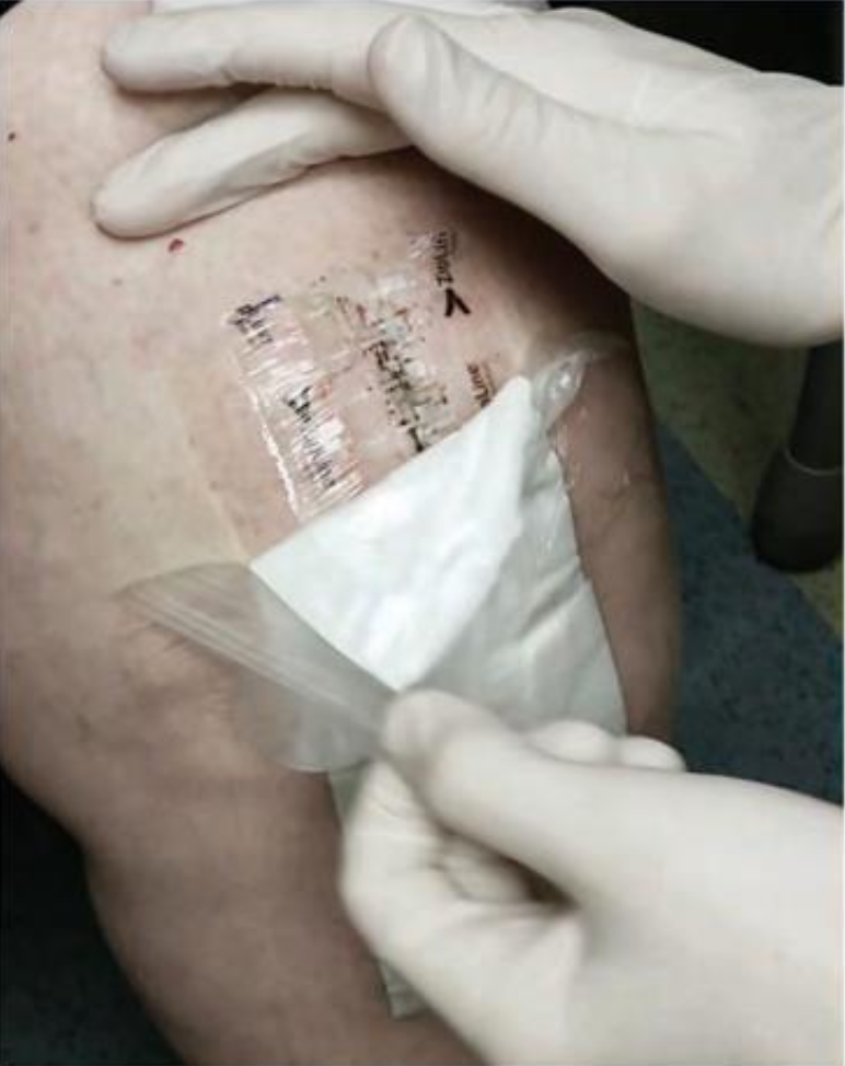Dressing removal step 1
