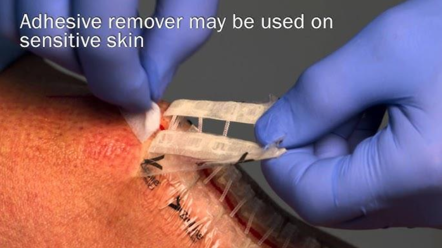 Dressing removal step 2