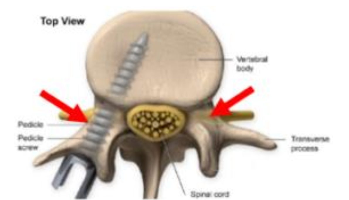 Spinal fusion step 1