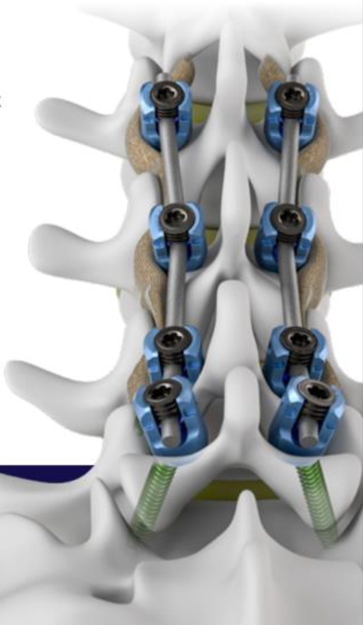 Spinal fusion step 2