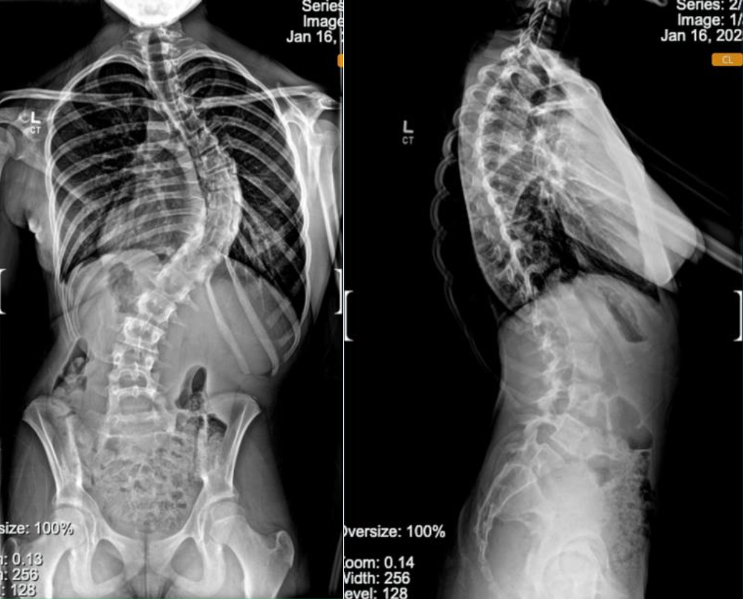 Scoliosis Before