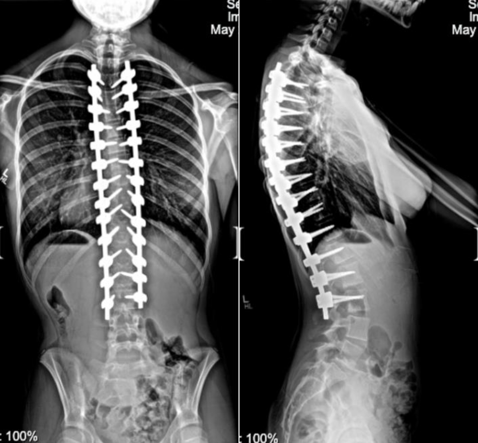Scoliosis After