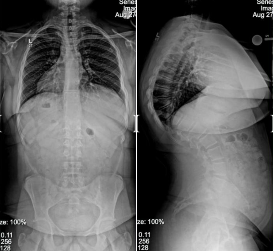 Kyphosis Before