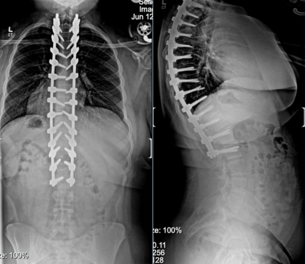 Kyphosis After